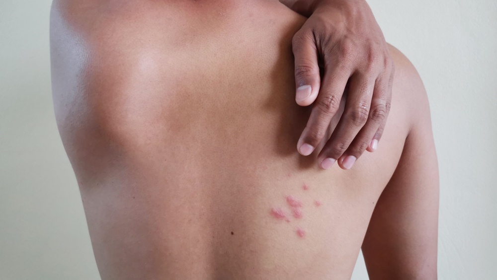 Έρπητας ζωστήρας: Η ανεμευλογιά που επιστρέφει